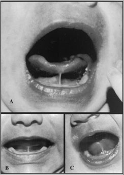 Complications of Tongue-Tie in Newborns